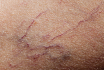 Preventing and Treating Thread Veins