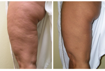 Non-Invasive Body Tightening and Contouring Treatments - EndyMed 3DEEP RF