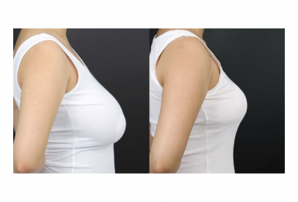 Breast Reduction Procedure: The Full Journey - What, How, Who?