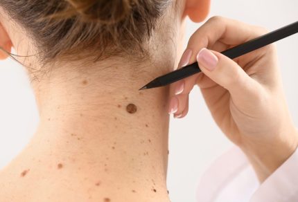 Mole Removal: Procedure, Benefits, Risks, and Recovery