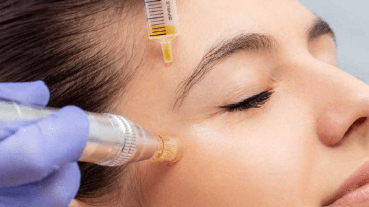 Microneedling combined with PRP