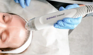 rf microneedling