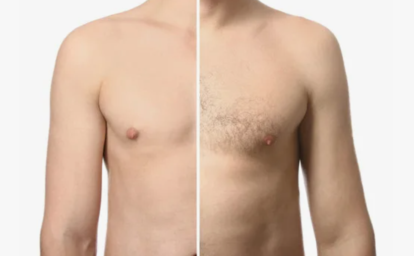 laser hair removal full body