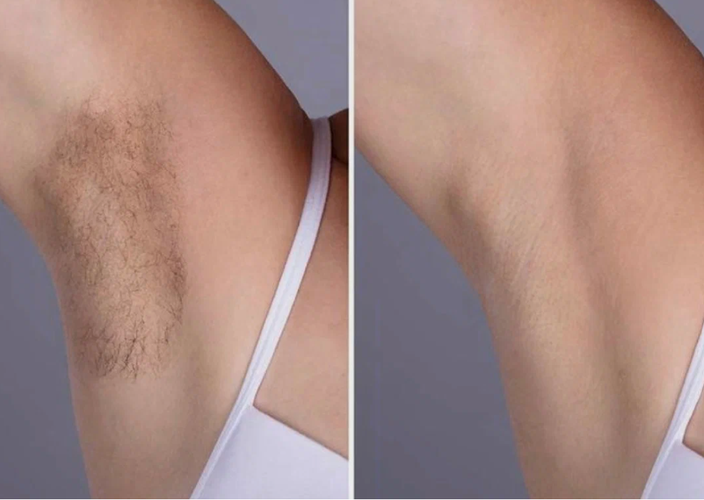 laser hair removal underarms