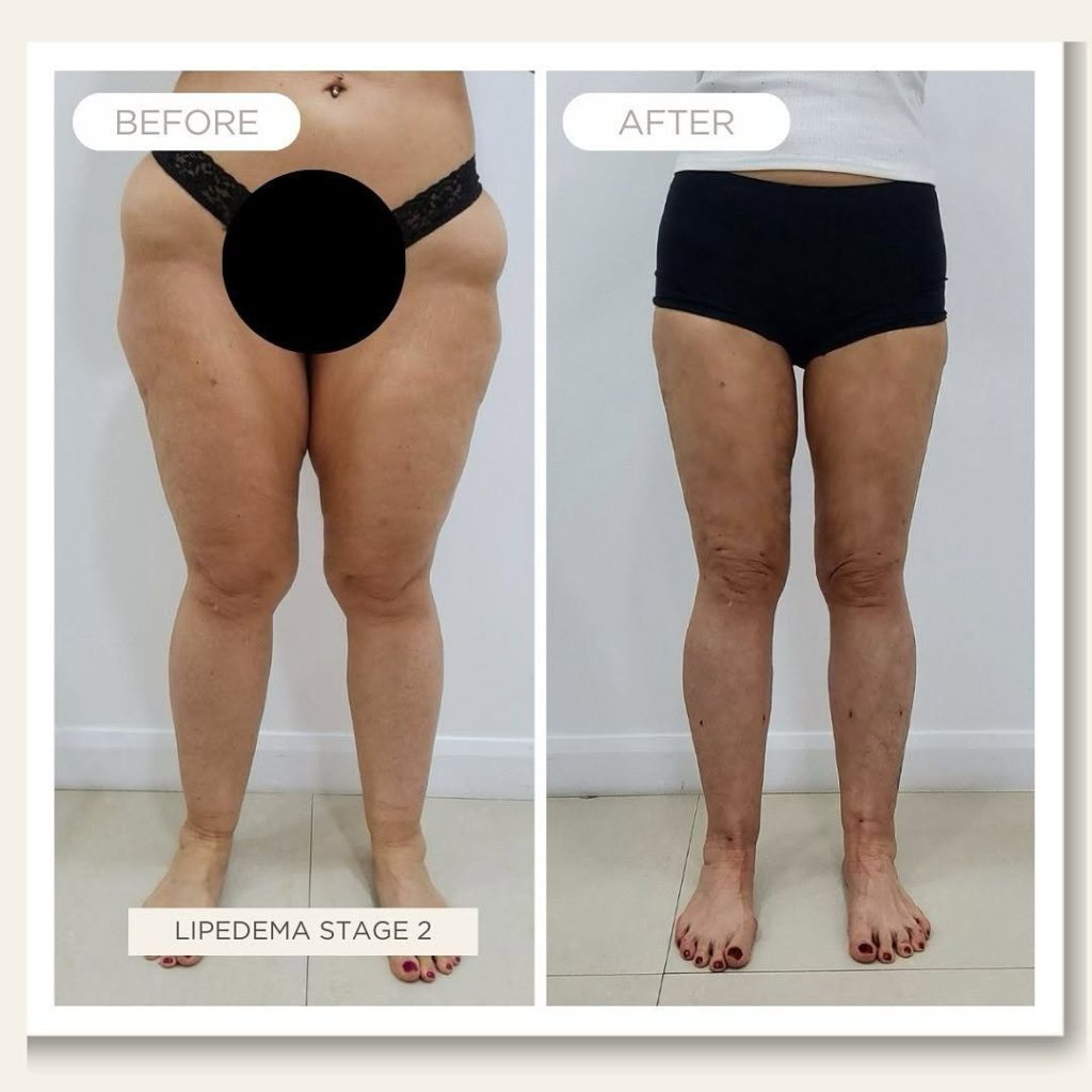 lipedema before after treatment