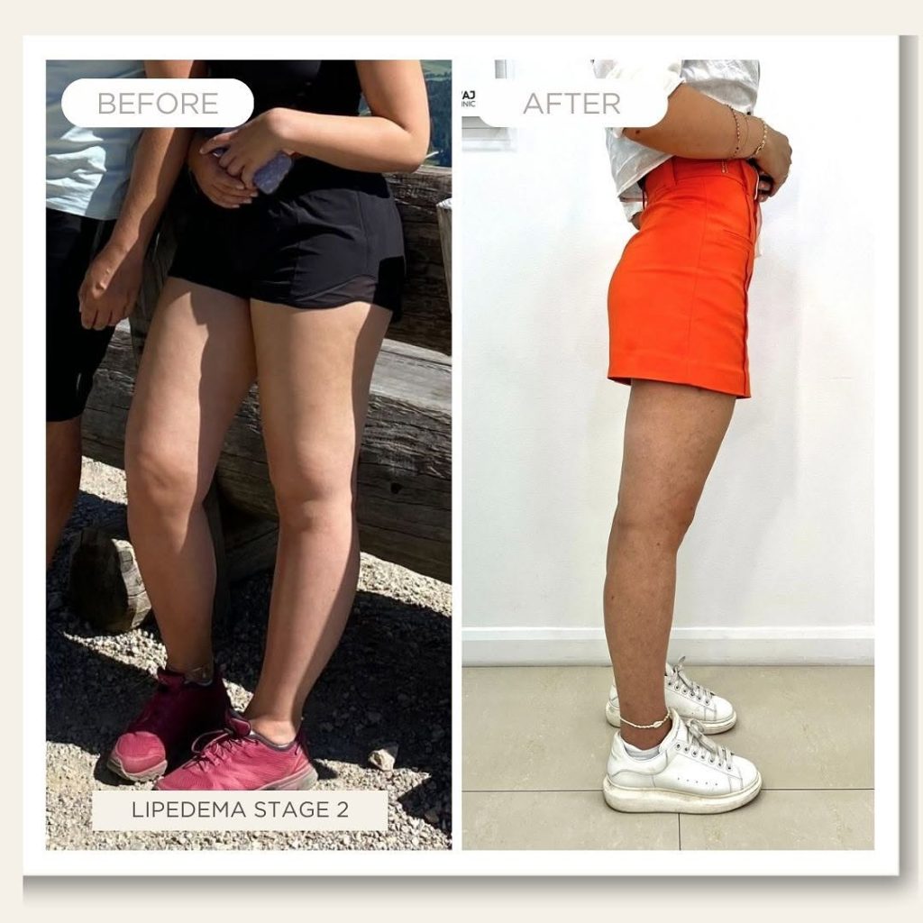 lipedema before after treatment