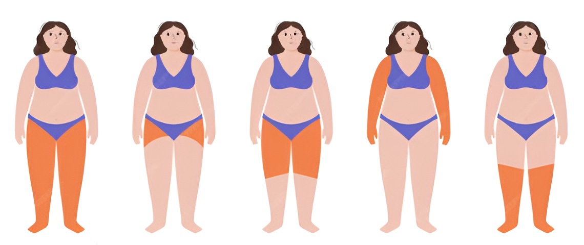 lipedema treatment dubai