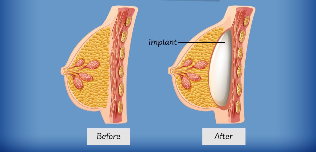 Anatomy of human breast implant