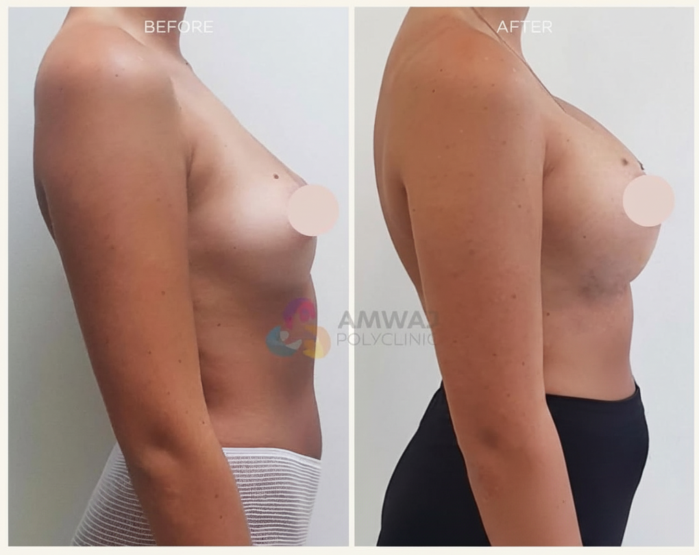 Dr. Tarek Bayazid delivers breast augmentation results that enhance confidence while maintaining a soft, natural look